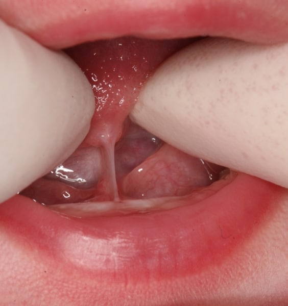 anterior tongue tie