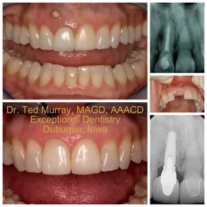 Dental Implants Dubuque
