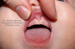 upper lip tie, laser revision, laser frenectomy