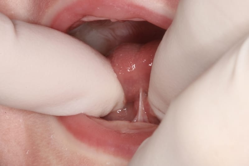 Tongue Tie Lip Tie CO2 laser dentist Iowa frenectomy revision