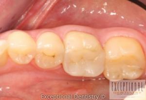 Porcelain Crowns And Onlays