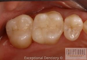 Porcelain Crowns And Onlays