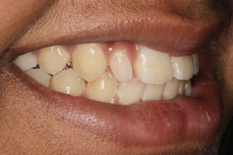 Dental Bonding Peg Lateral Exceptional Dentistry Dr. Ted Murray