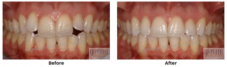 Invisalign b a 1