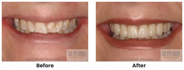 porcelain veneers b a