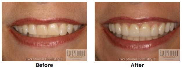 porcelain veneers b a1