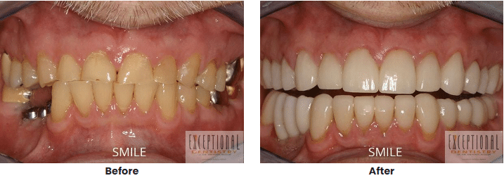 Full Mouth Reconstruction 1