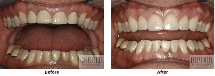 Porcelain Crowns And Onlays 2