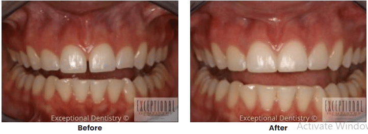 Cosmetic Bonding 1