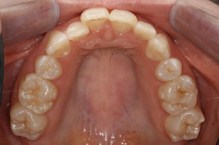 Invisalign Dentist near me Exceptional Dentistry Dr. Ted Murray