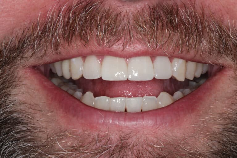 After Image: Porcelain Veneers - front
