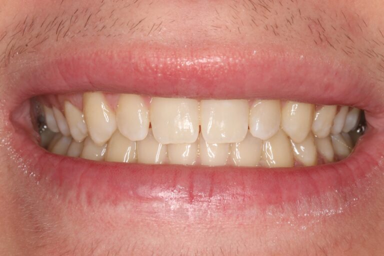 Before Image: ZOOM teeth whitening Dubuque - front