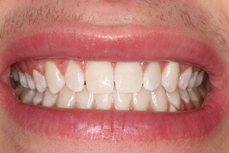 After Image: ZOOM teeth whitening Dubuque - front