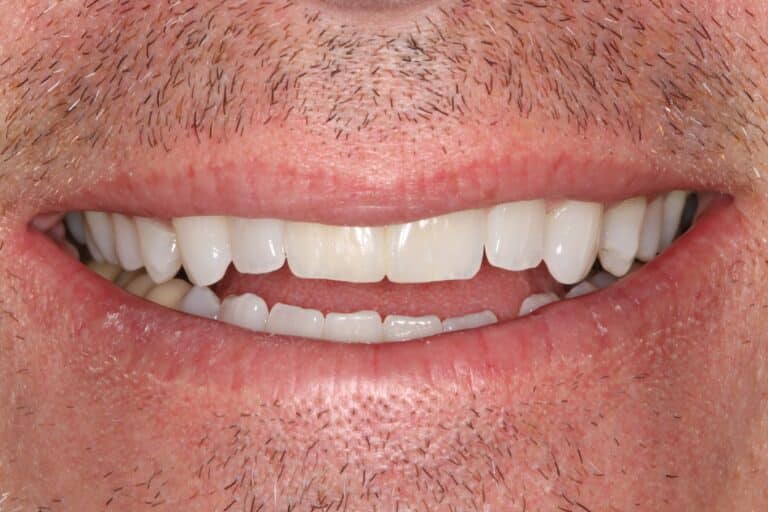 After Image: Cosmetic Bonding - front