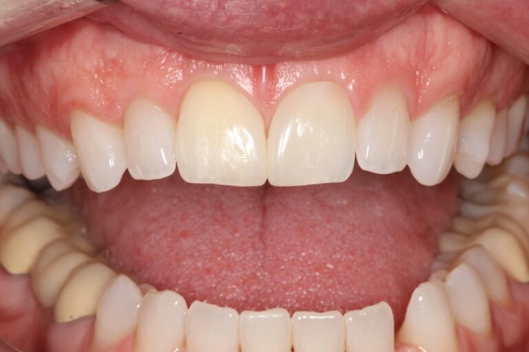 After Image: Cosmetic Bonding - front