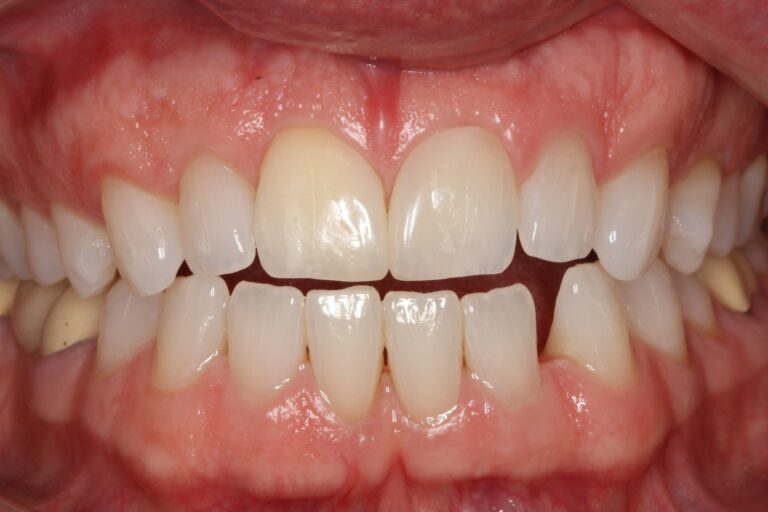 After Image: Cosmetic Bonding - front