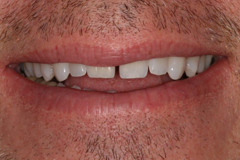 Before Image: Cosmetic Bonding - front