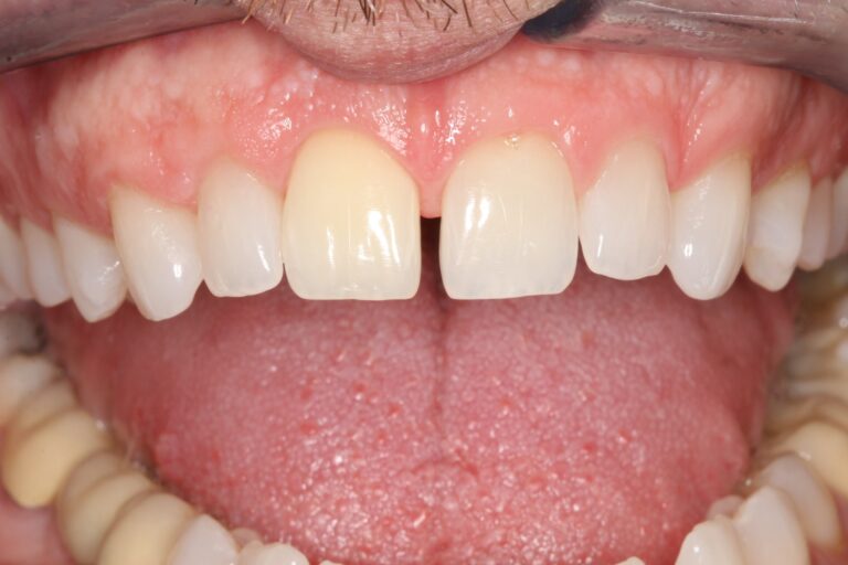 Before Image: Cosmetic Bonding - front