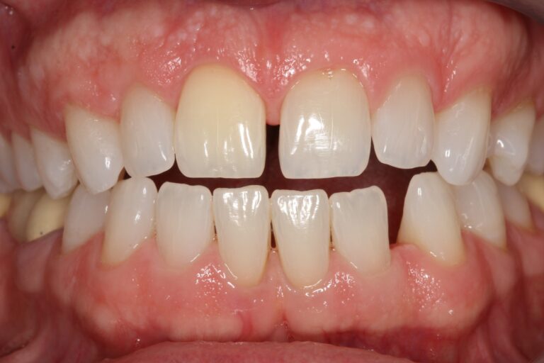 Before Image: Cosmetic Bonding - front